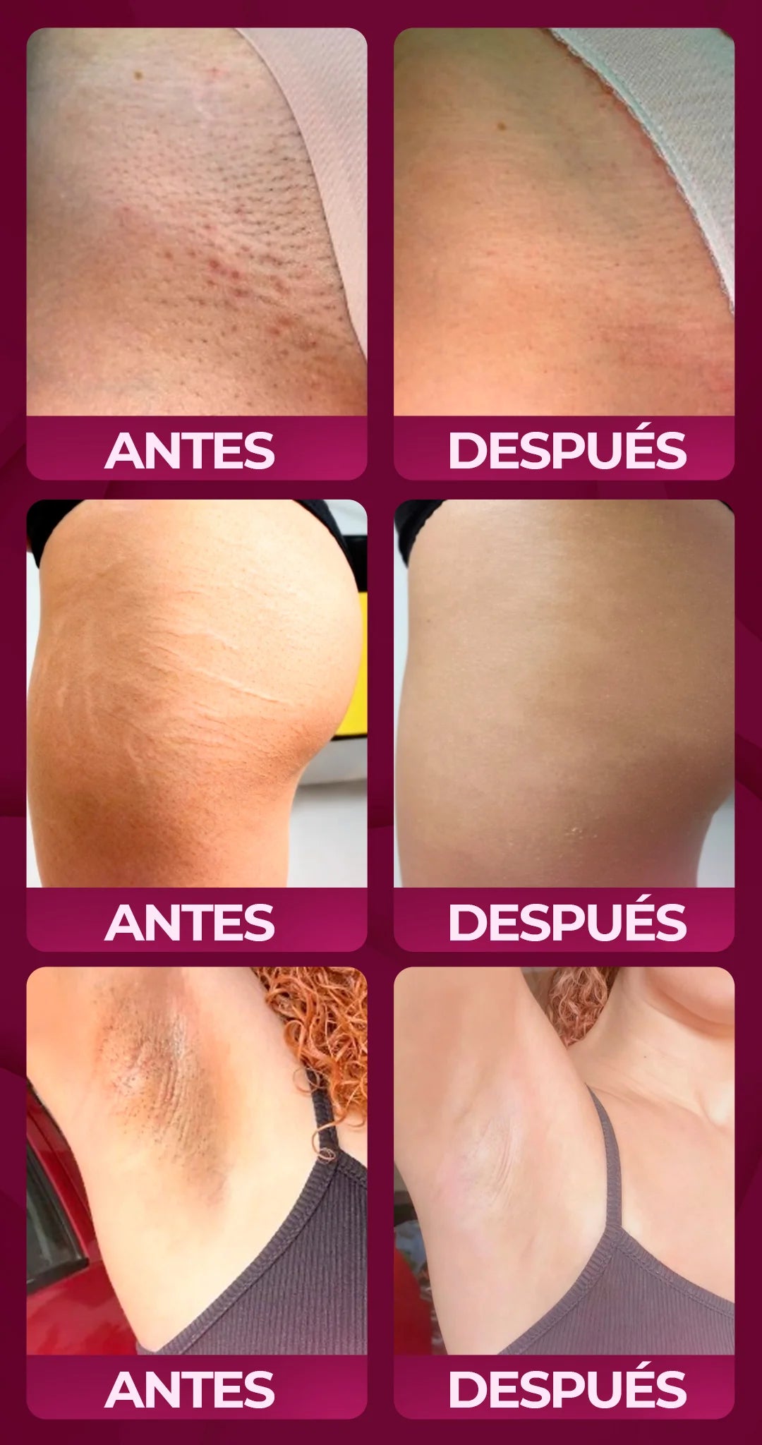 Antes y después en la ingle
